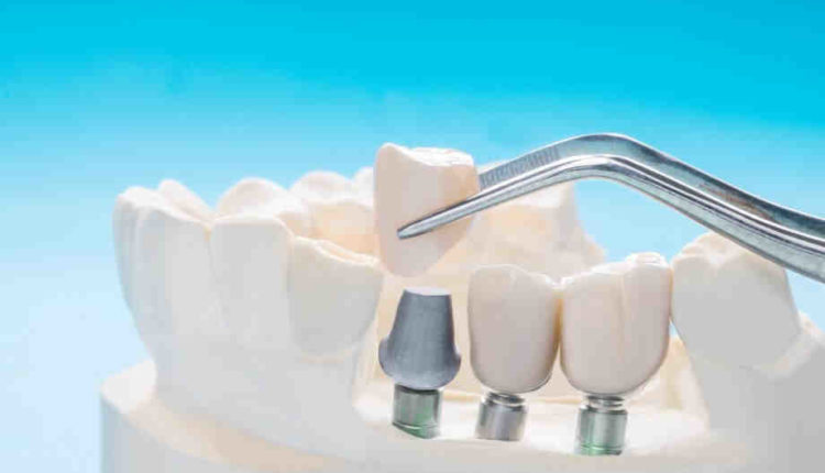 Can a dental bridge be attached to an implant?