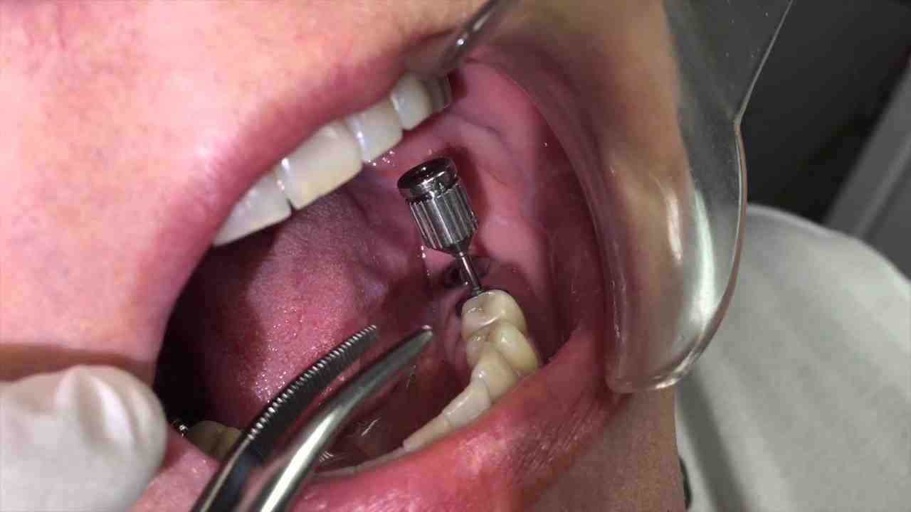 Can a dental implant abutment break?