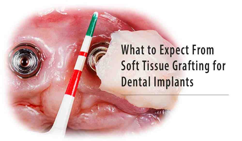 Can a dental implant be done in one day?