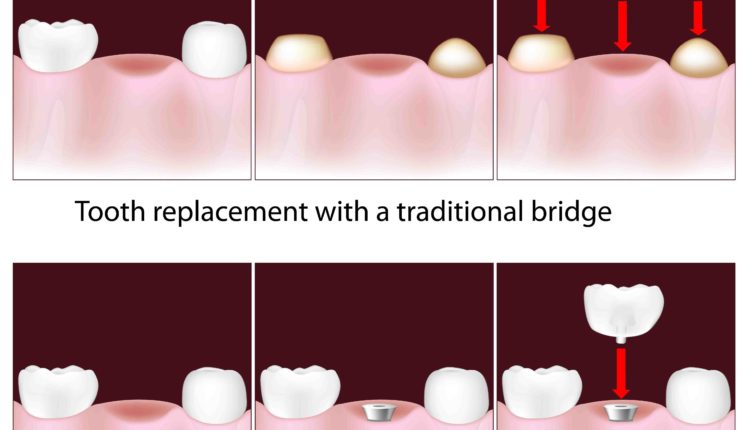 Can a dental implant be used for a bridge