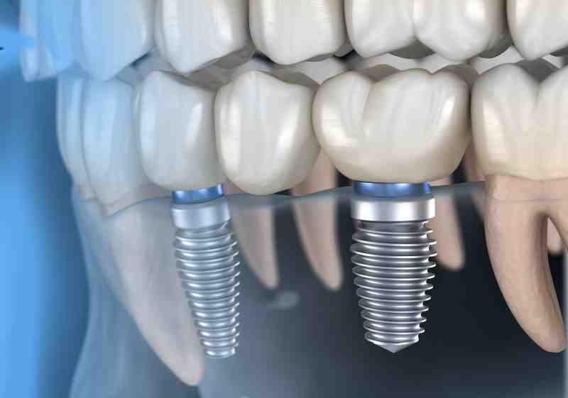 Can a dental implant fail after 2 years?