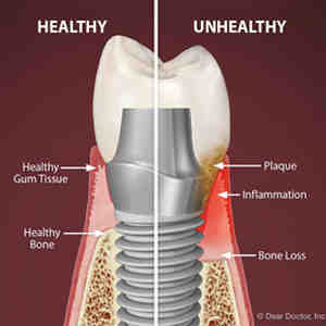 Can a dental implant fail after 5 years?
