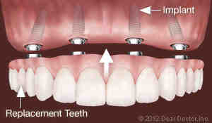 Can a failed dental implant be saved?
