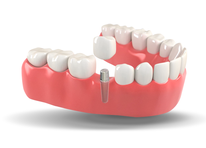 Can a loose crown be Recemented?