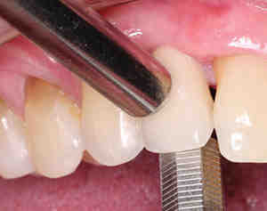 Can a loose implant be saved?