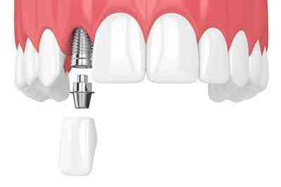 Can a loose implant crown cause pain?