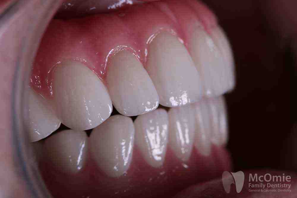 can-a-dental-implant-crown-be-placed-backward-dental-news-network