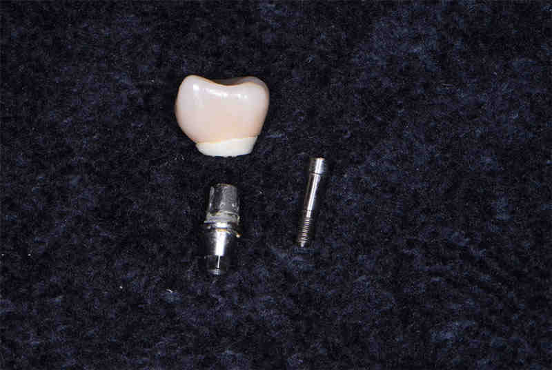 Can an abutment break?