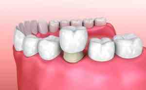 Can an implant crown be tightened?
