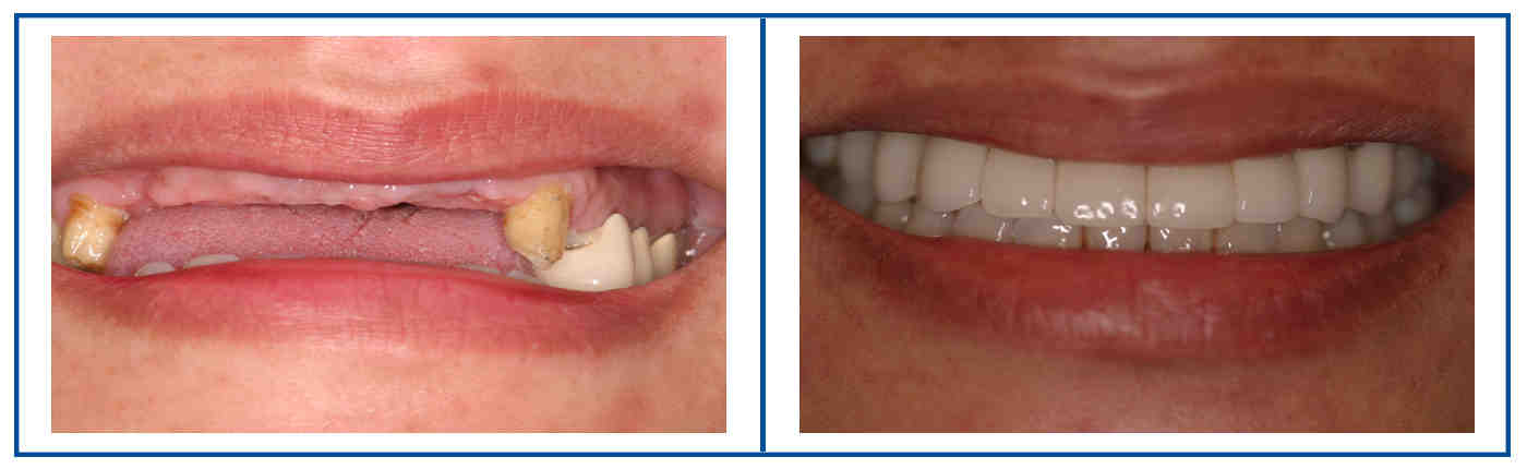 Can an implant hold more than one tooth?