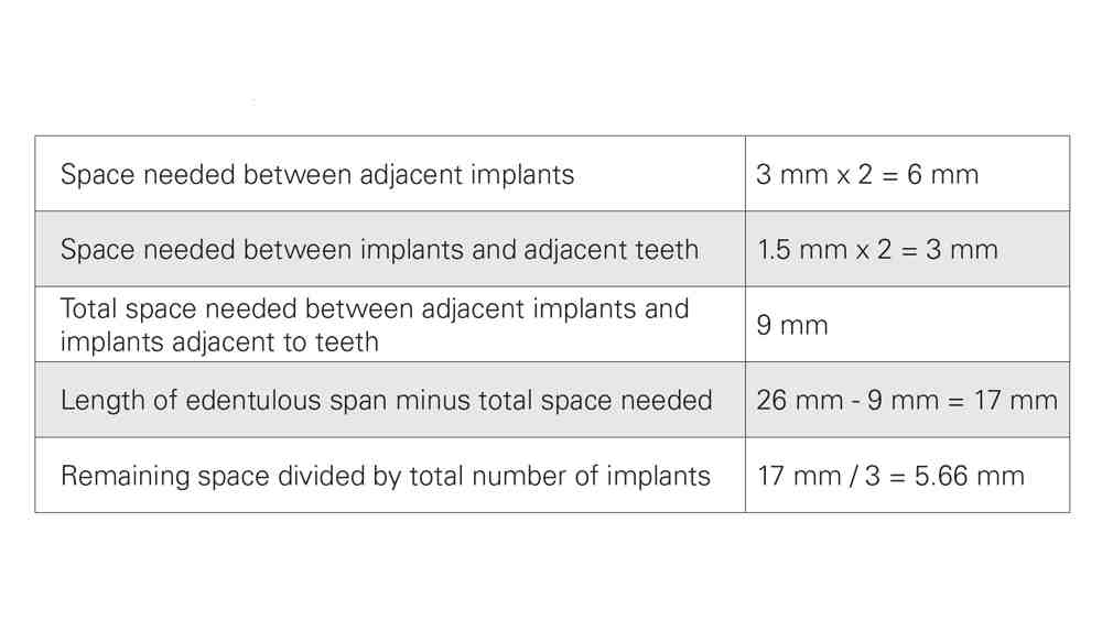 Can an implant hold more than one tooth?