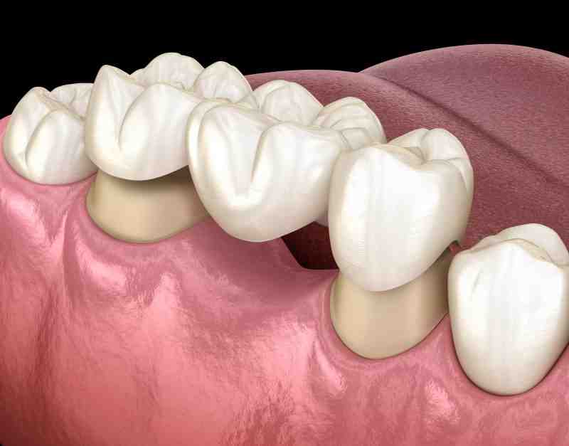 Can an infected implant be saved?