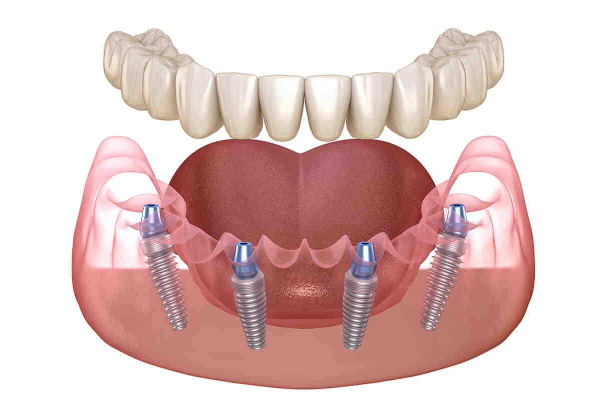 can-you-sue-for-nerve-damange-after-dental-implants-dental-news-network