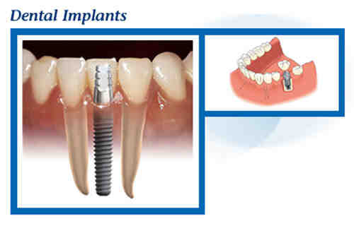 Can blood thinners affect your gums?