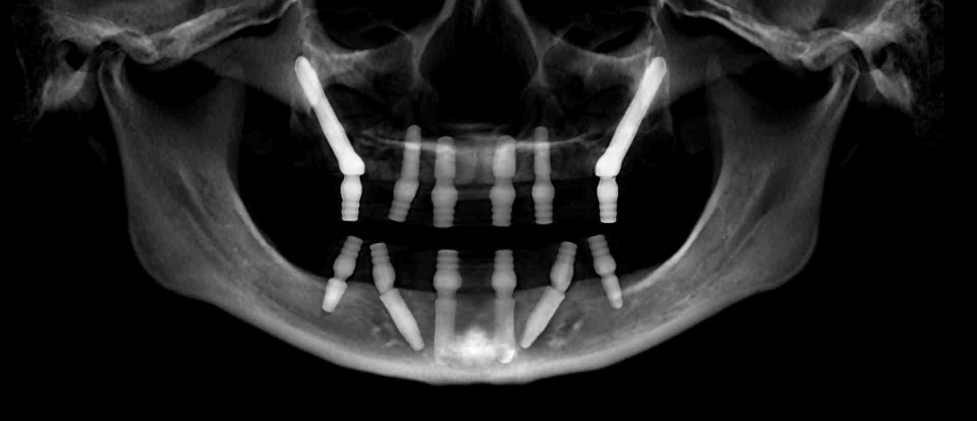Can bone loss in mouth be reversed?