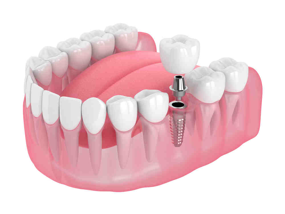 can-delta-dental-insurance-help-with-getting-fixed-implants-dental