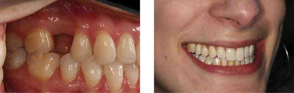 Can dental implants be done in one day?