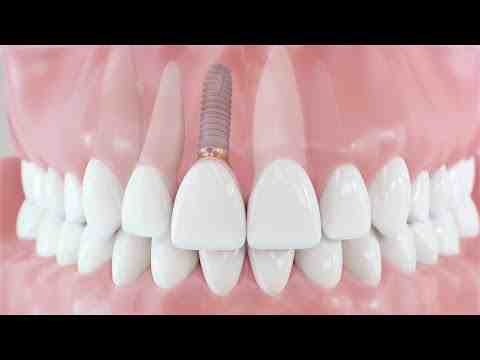 Can dental implants be done in one day?