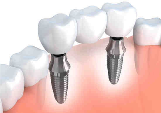 Can dental implants be redone?