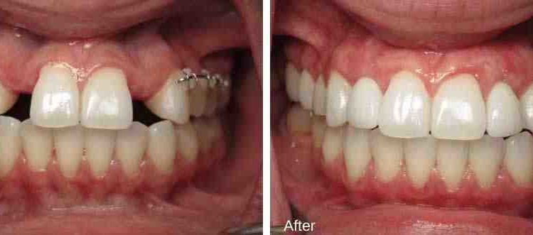 Can dental implants be too white