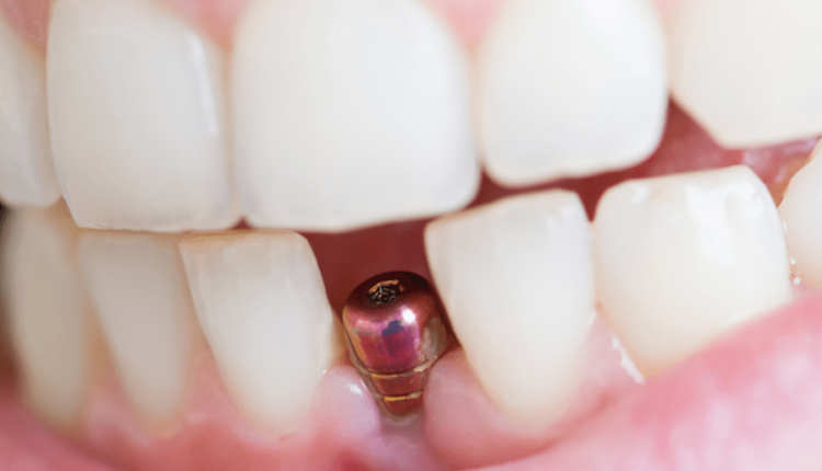 Can dental implants become infected