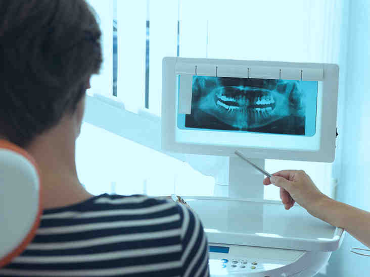 Can dental implants cause a stroke?