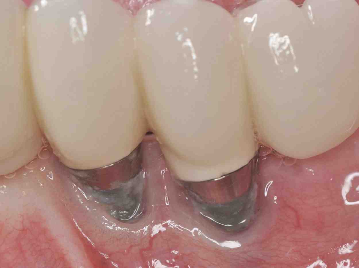 what-are-some-complications-from-dental-implants-dental-news-network