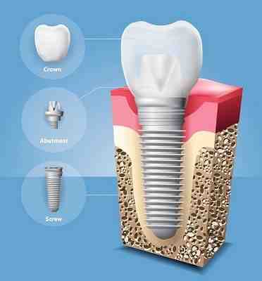 Can dental implants cause death?