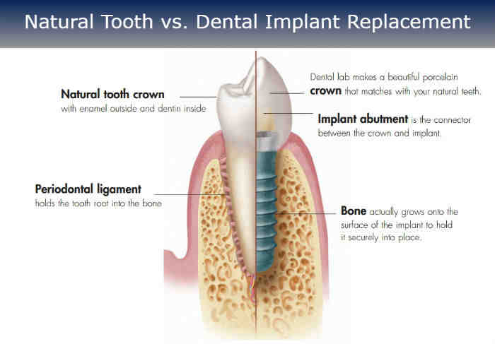 Can dental implants cause health issues?