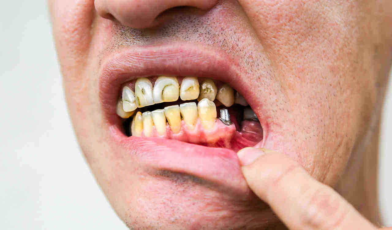 Can dental implants cause problems years later?