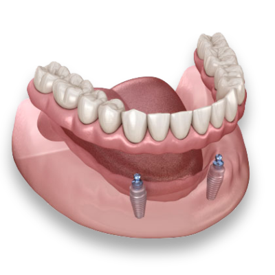 Can dental implants cause problems years later?