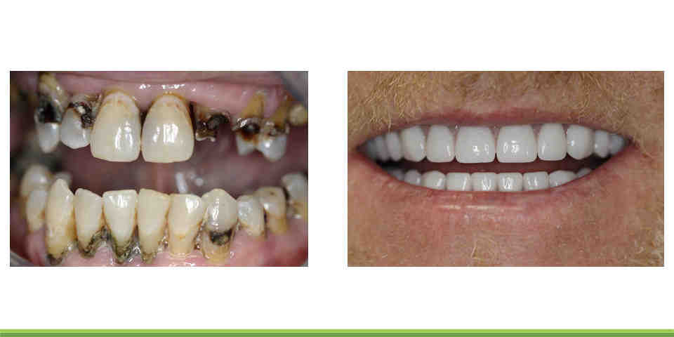 Can dental implants get infected years later?