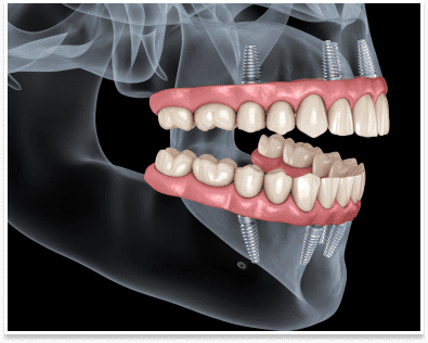 Can dental implants get infected years later?