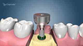 Can dental implants get infected years later?