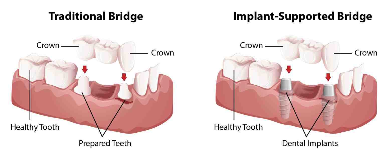 Can dental implants get infected years later?