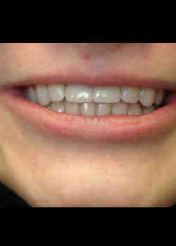 Can dental implants get infected years later?