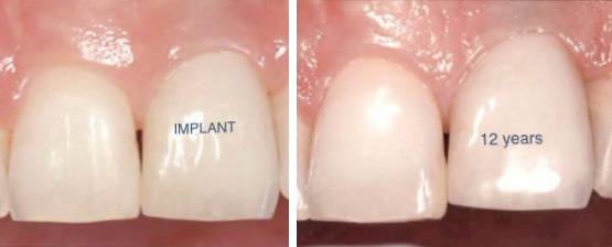 Can dental implants get infected years later?