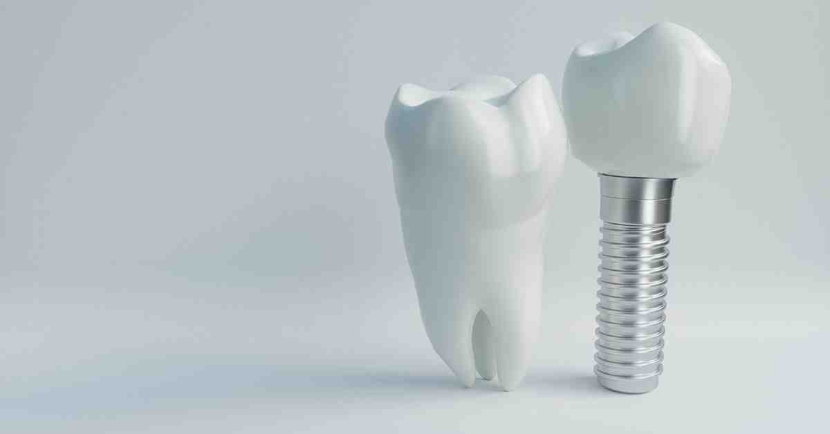 Can dental implants last forever?