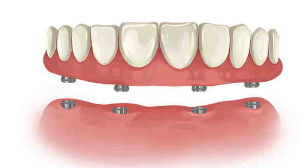 Can dentures be permanently glued in?