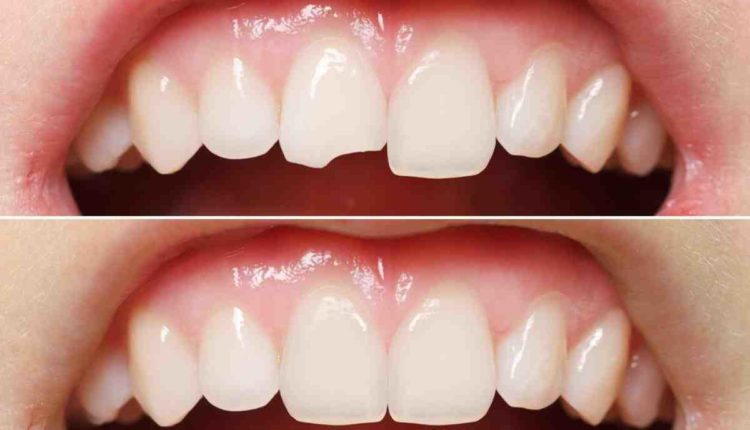 Can food get under dental implants