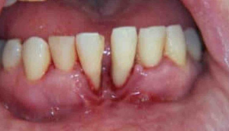 Can i get a dental implant if i have diabetes