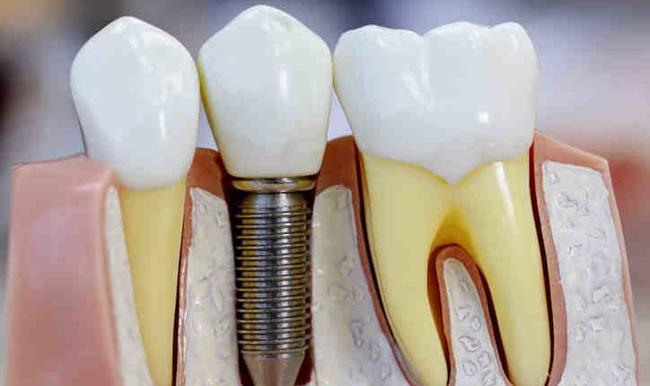 Can i get dental implants with bone loss