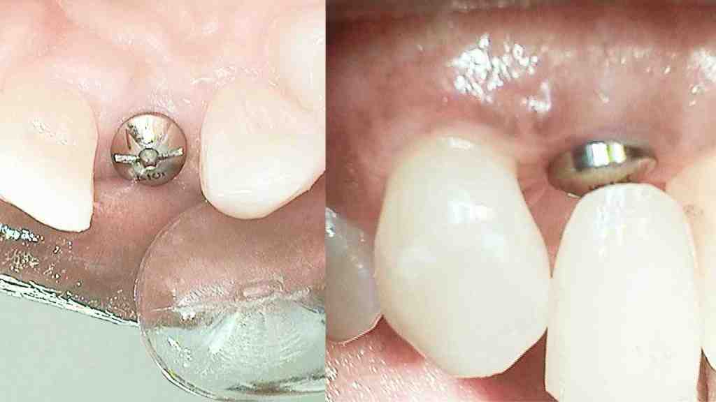 Can implant be done for one tooth?