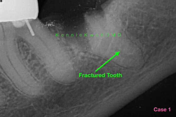 Can implant be done immediately after extraction?