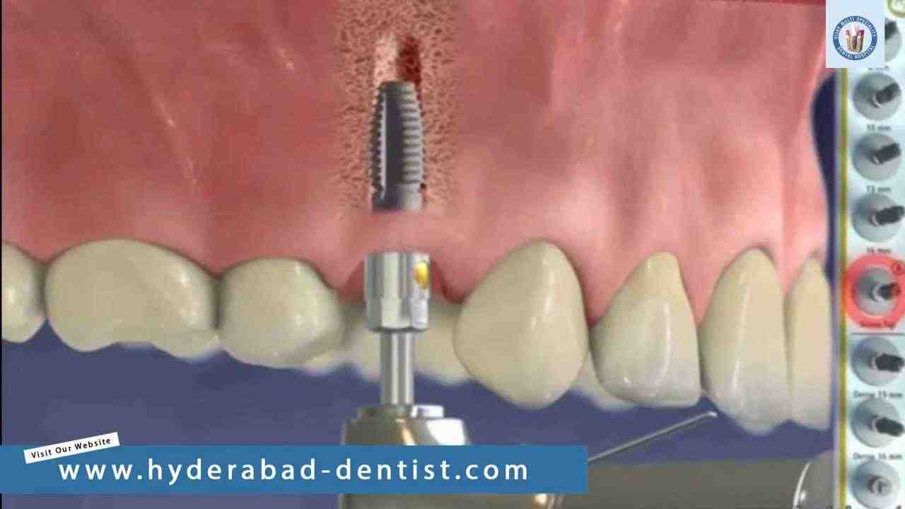 Can implant failure be fixed?