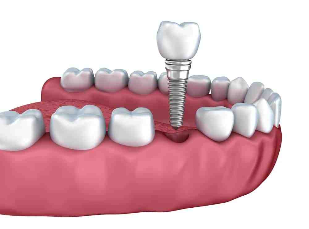 Can implant screws fall out?