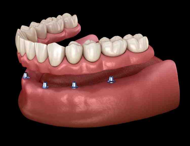 Can implants fail years later?