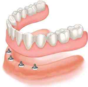 Can mini implants be replaced?