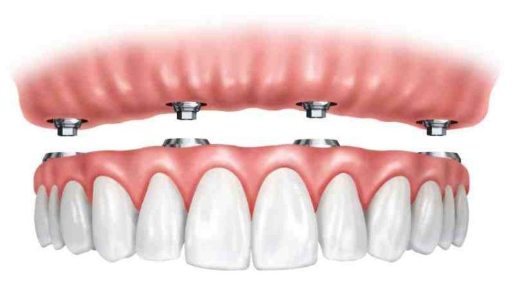 Can not javing adeep cleaning afdect an dental implant?