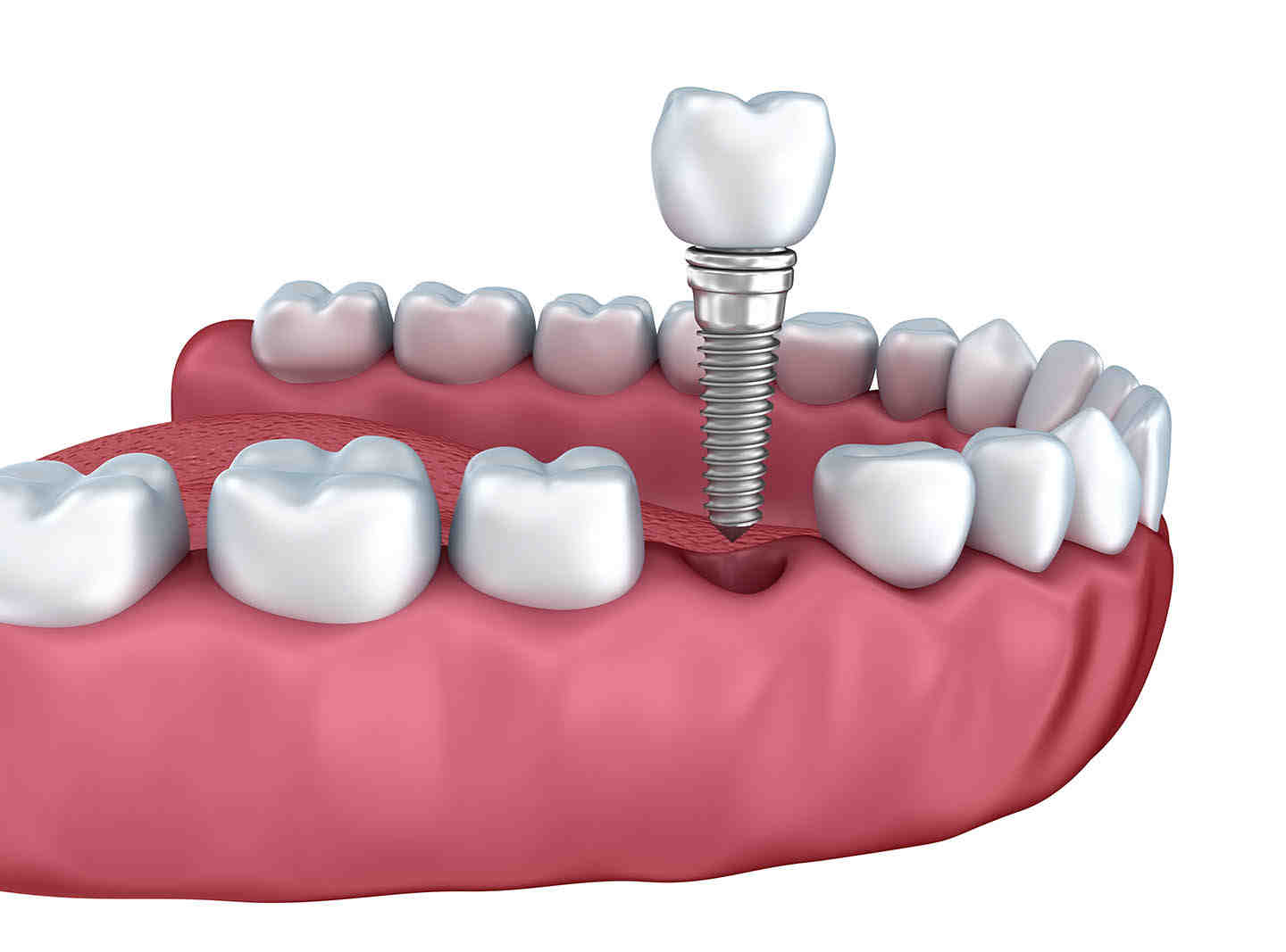 Can one implant support two crowns?